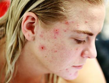 Czym jest trądzik kosmetyczny i na czym polega jego leczenie? Przyczyny, objawy, sposoby pielęgnacji skóry